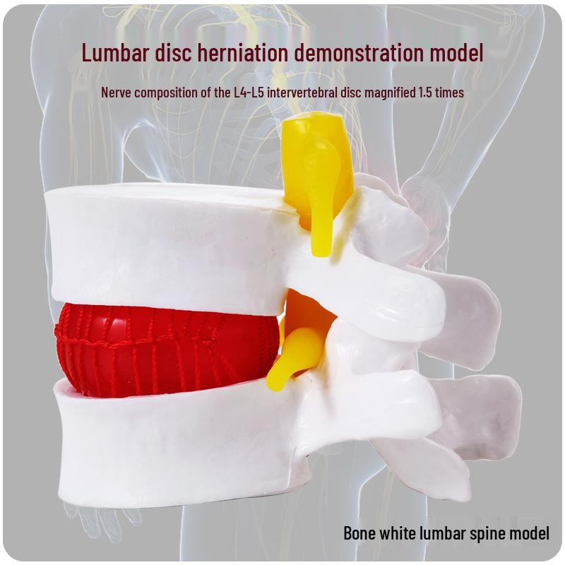 

Подлинная медицинская модель патологии поясничного отдела позвоночника: Демонстрация протрузии межпозвоночного диска