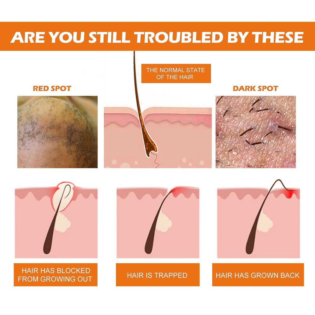 30 ml Essens-Vokser Inne i Håret, Reduserer Rødhet, Forhindrer Hår i å Vokse Innover, og Lindrer Etter Skjeggessenser