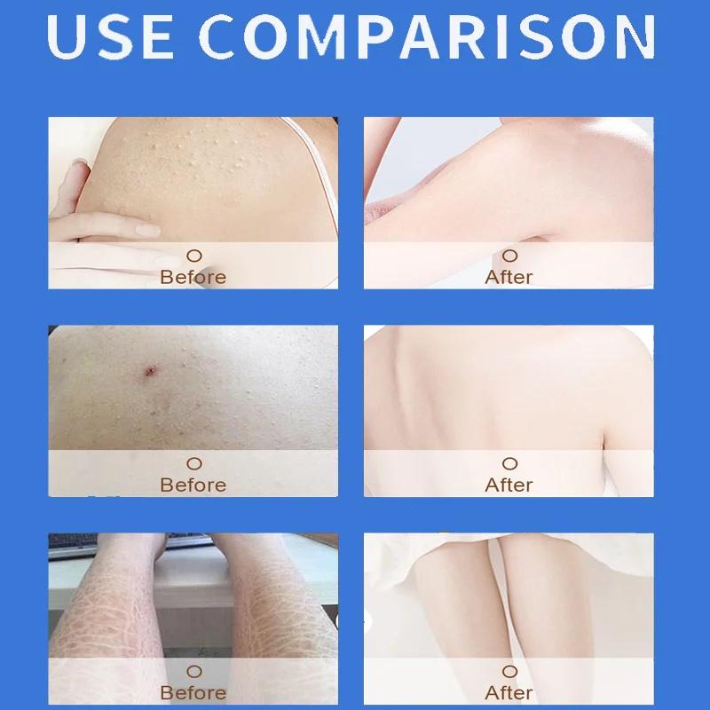 Body Whitening Cream Keratosis Pilaris Treatment Bumpy Rough Chicken Follicle Skin Repair Strawberry Legs Removal Dry Skin Care