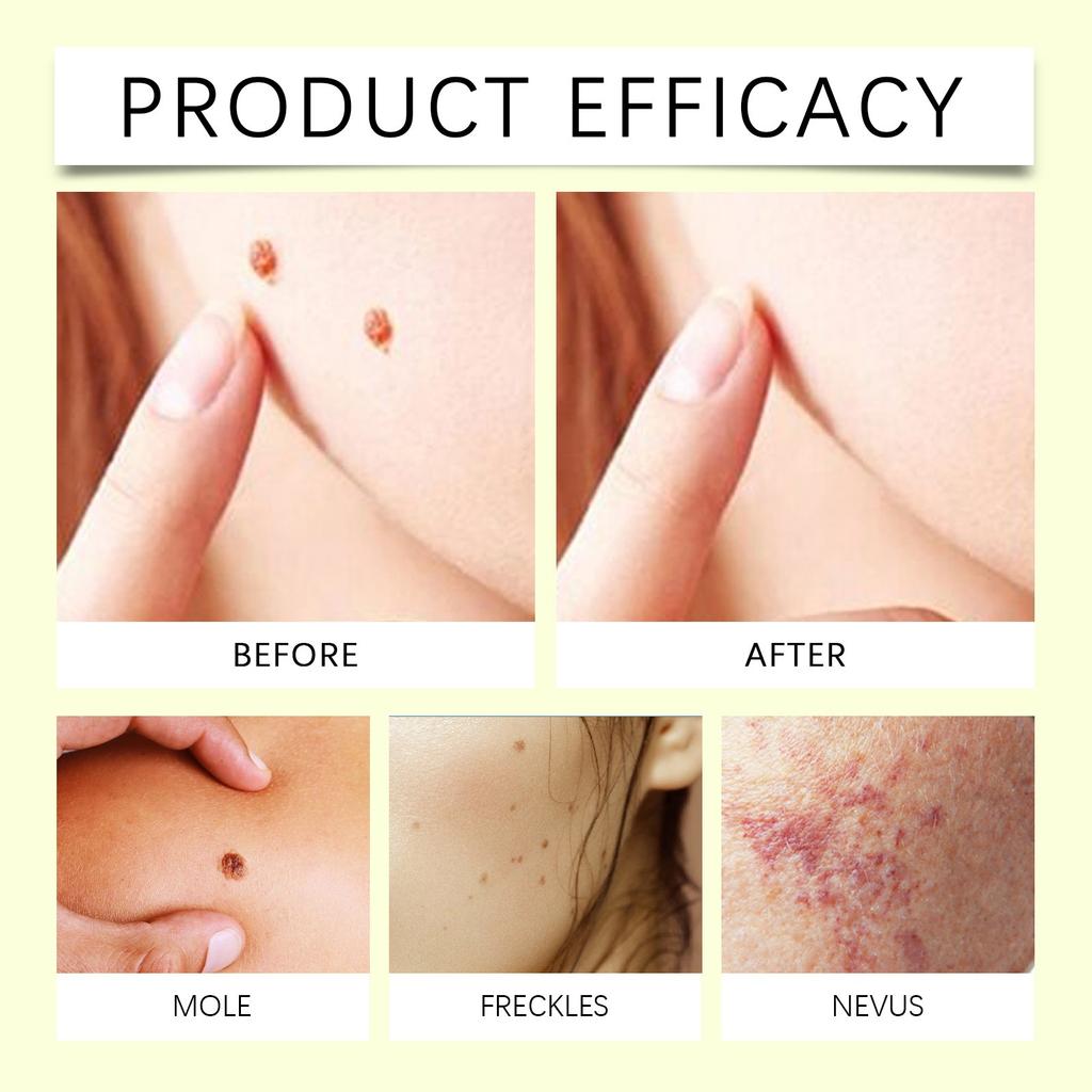 Dark Hyperpigmentation Remover For Face, Dark Hyperpigmentation Serum,Age,Brown,Acne ,Melasma Brown Dosing With For Women And Men 50g