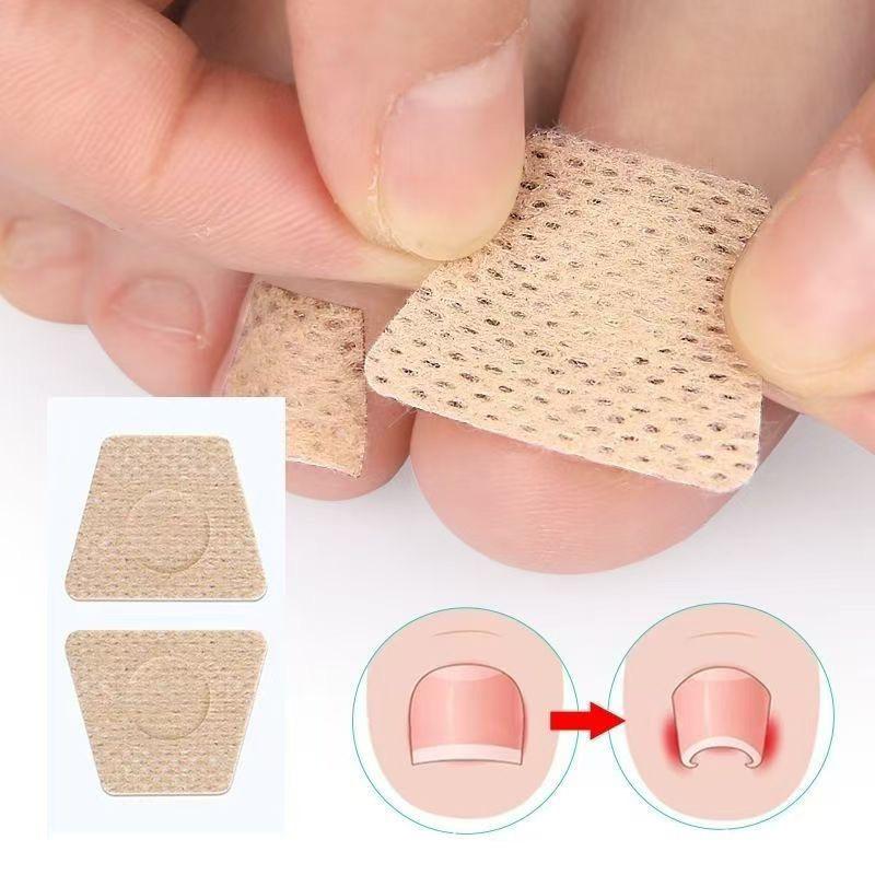 Nail Patch Ingrown Toenail Correction Nail Sticker Foot Pulling Patch Glue-Free Foot Sticker Nail Groove Ingrown Toenail Correction Nail Care Patches