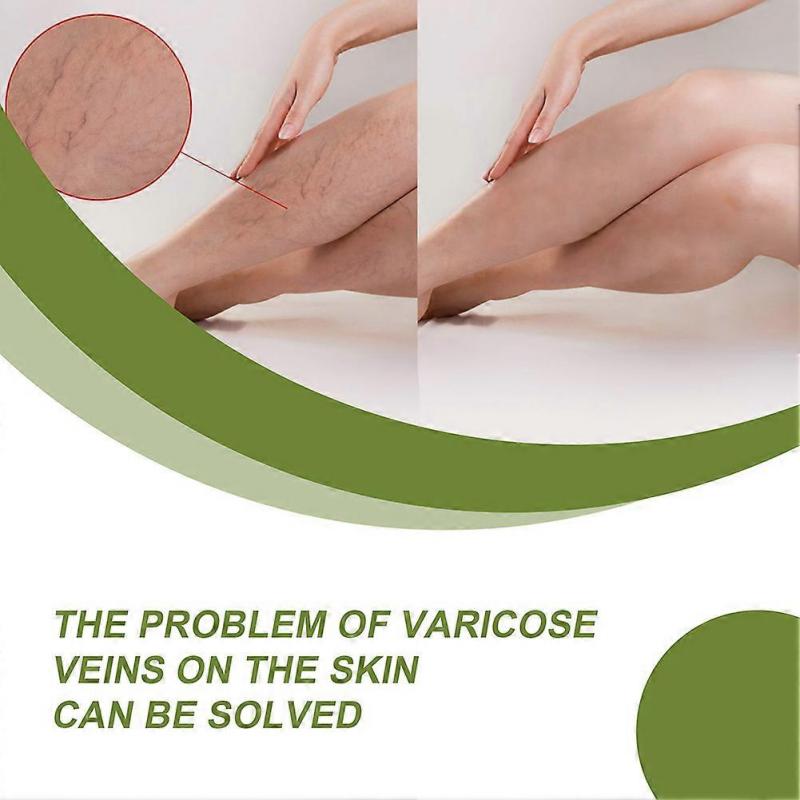 50g Varicose Veins Cream, Effective Varicose And Spider Veins Treatment