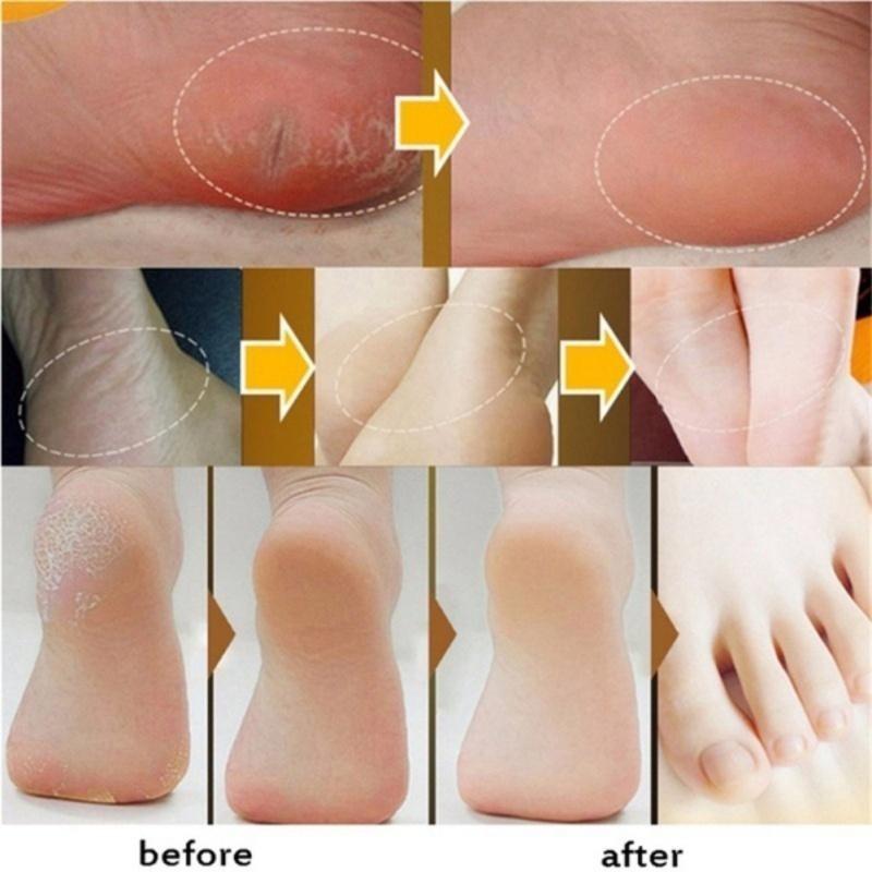 Effective Odor Treatment Nourishing Anti Cracking Cream Skin Care Products Dead Skin Remover Chapped Repair Cream
