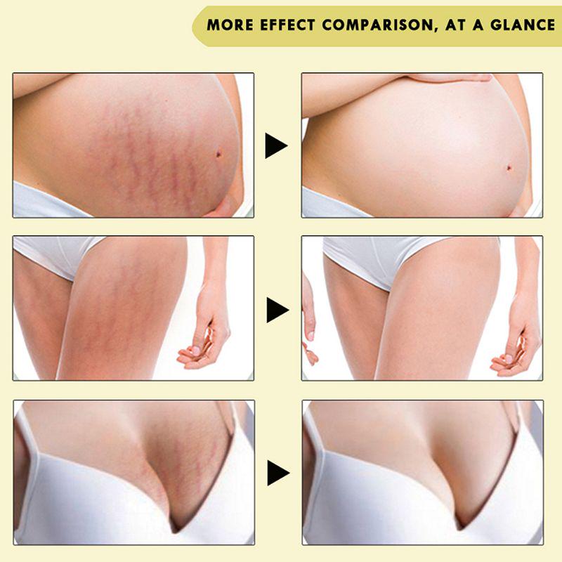 cara menggunakan oedo rose remove stretch mark cream