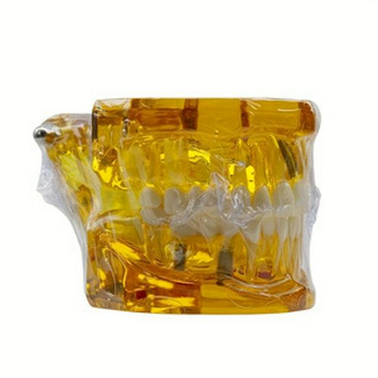 Transparent Dental Implant Restoration Model with Implant Bridge