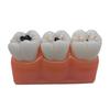 Caries Evolution Demonstration Model: 4x Enlarged Tooth for Doctor-Patient Communication