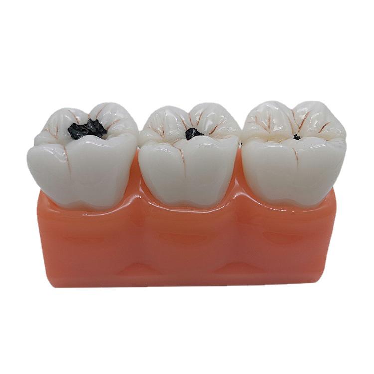 Caries Evolution Demonstration Model: 4x Enlarged Tooth for Doctor-Patient Communication 4x Caries Model M1