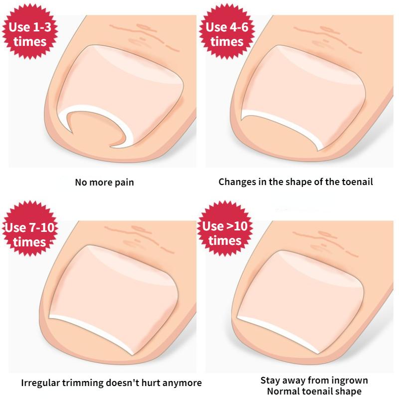 Straightening Clip Ingrown Toenail Corrector Pedicure Foot Nail Care Tools Stainless Steel Pedicure Treatment Onyxis Correction