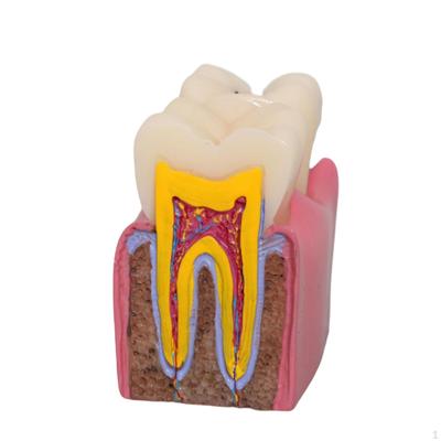 Caries Tooth Model 6 Times Roots Canal Morphology Teaching Display Resin for Studying Class
