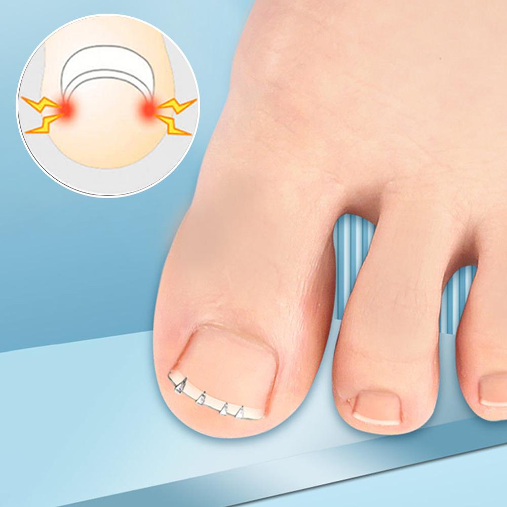 Ingrown Toenail Pedicure Tool Embed Toe Nail Care Straightening Correction Clip Curved Clamp Toenails Correction Tool for Toes