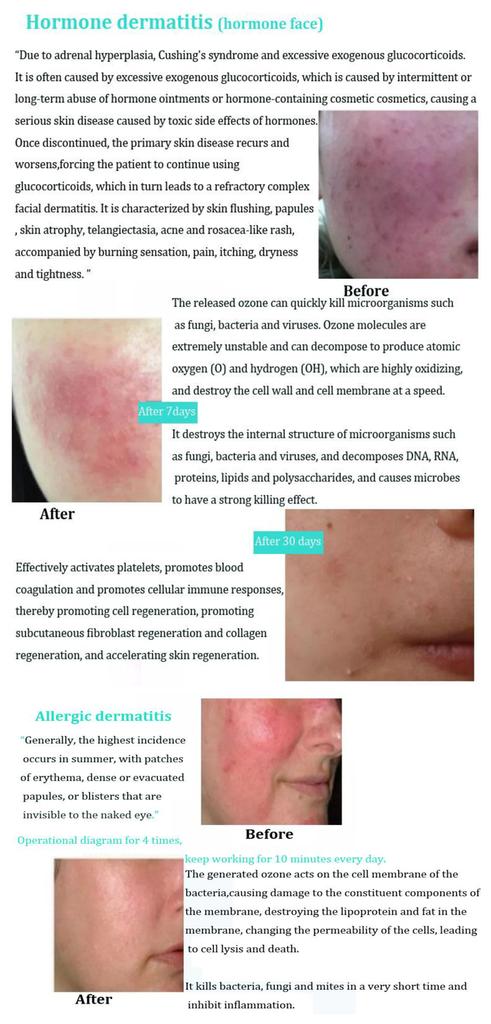 Profesionální ozónové plazmové pero pro zmírnění stárnutí pleti, omlazení pleti, bělení, léčbu akné, plazmové pero