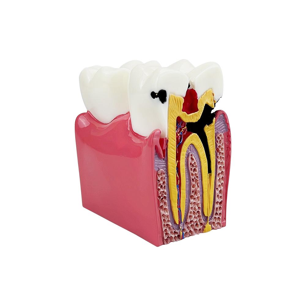6 Times Molar Pathology Anatomical Model Dental Comparison Model For Dentist Patient Communication Education Teaching Studying