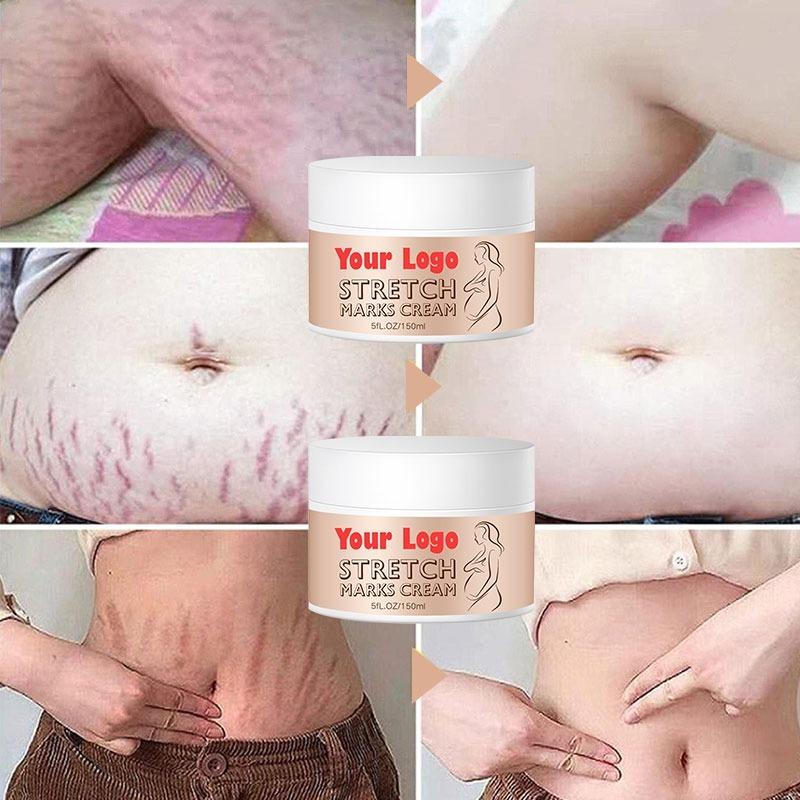 Best Selling Natural Organic Anti Pregnant Scar Skin Care Repair Treatment Cream