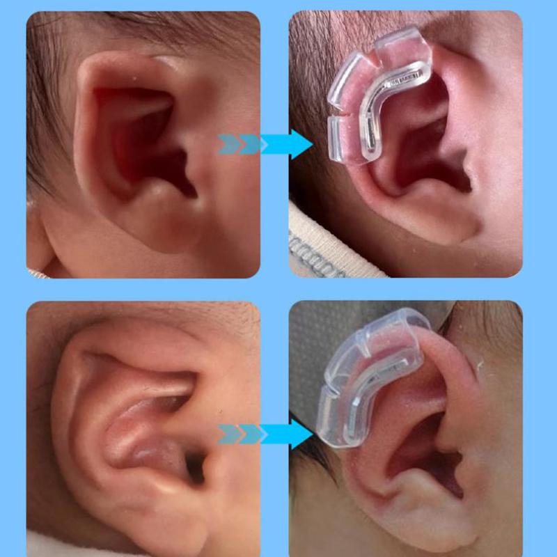 Protruding Ear Support Infant Corrector Tools Silicone Auricle Correction Patch For Baby Ear Corrector Auricle Valgus Correction