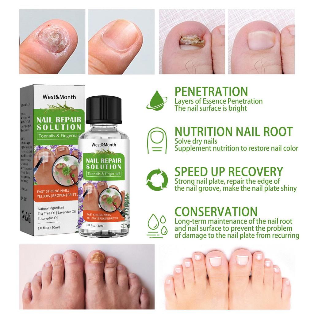 Toenail Fungus Care, FastActing Nail Care Liquid For Fungus Under & Around  Restores The Healthy Appearance Of Nails 30ml