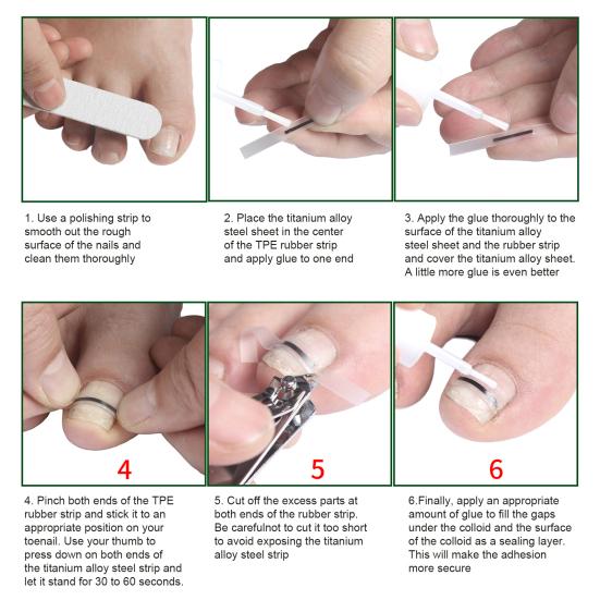 Yousheng Titanium Alloy Ingrown Toenail Corrector Kit for Curved Nail Repair Ingrown Toenail Treatment Tool Toe Nail Straightener