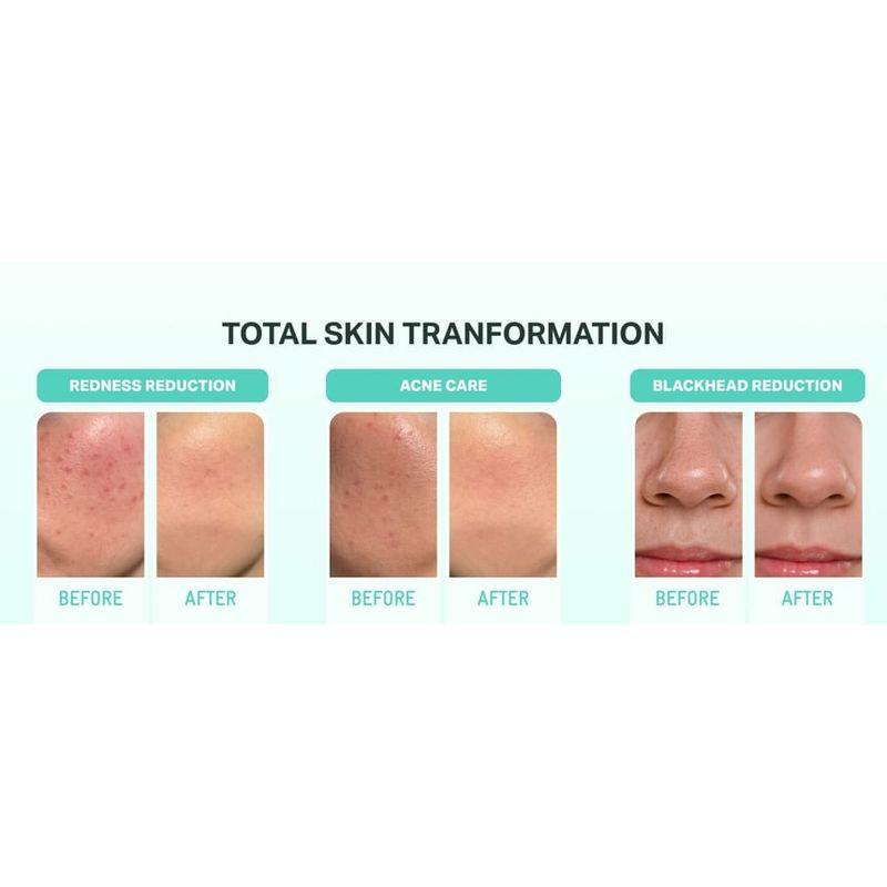 BRING GREEN - Zink Teca Unreinheiten Serum
