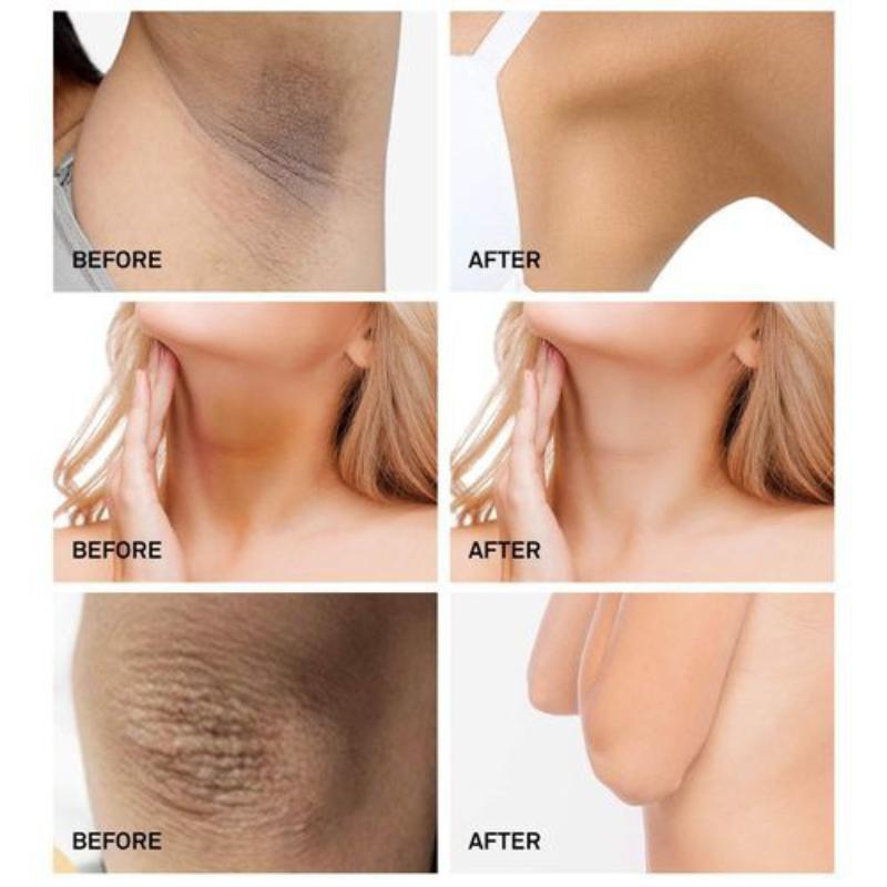 Crema de albire Sub Brat Piele Inchisa Picioare Genunchi