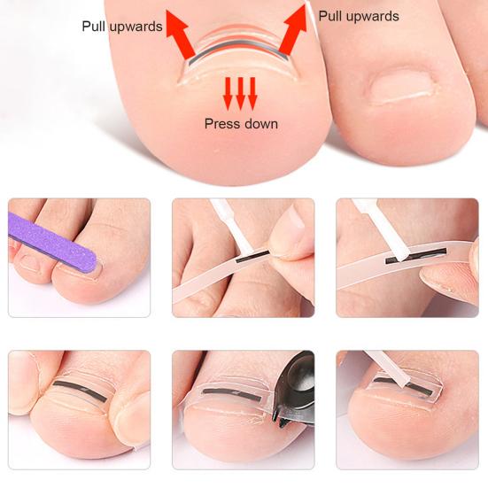 Yousheng Titanium Alloy Ingrown Toenail Corrector Kit for Curved Nail Repair Ingrown Toenail Treatment Tool Toe Nail Straightener