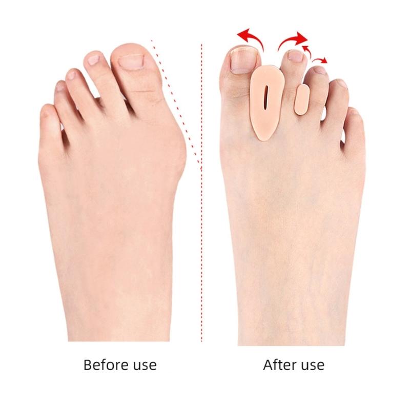 2Pack Orthopedic Toe Separators with Reinforced Forefoot Cushion and Ventilation for Improved Posture and Support