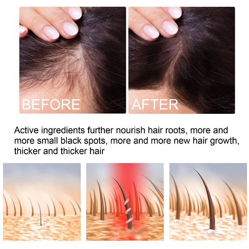 EELHOE Hair Growth Spray Essential Fast Regrowth Serum Beard Growth Oil Hair Loss Care Beauty Hairline Scalp Treatment for Men Women