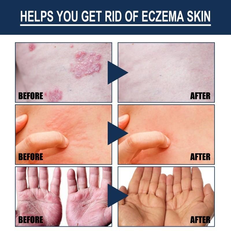 South Moon Skin Care Spray For Relief Of Itchy Skin And Eczema Symptoms In 30ml Bottle