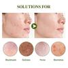 Ouhoe Blackhead Removal Essence Set - Cleanses Pores, Refines Skin, Controls Oil, Repairs Acne, Blackheads, And Nose Strips
