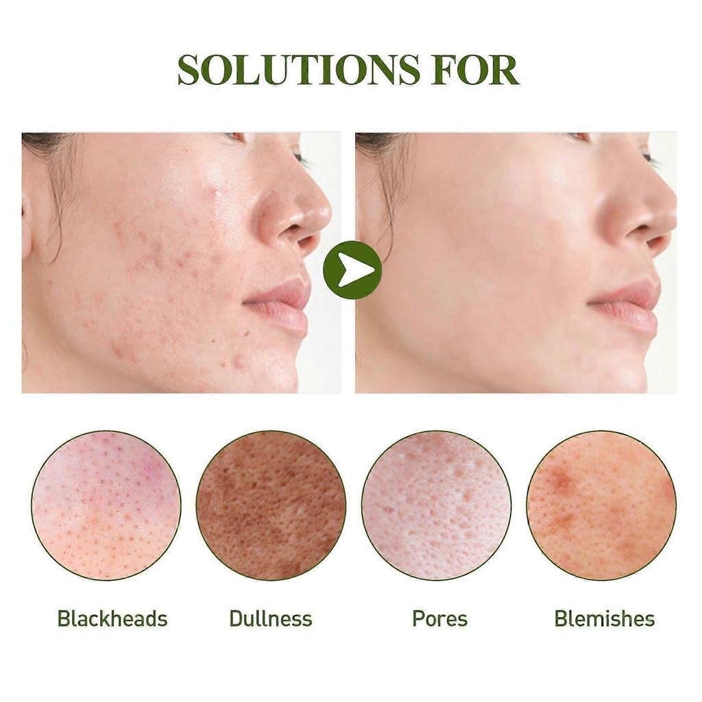 Ouhoe Blackhead Removal Essence Set - Cleanses Pores, Refines Skin, Controls Oil, Repairs Acne, Blackheads, And Nose Strips