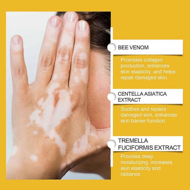 Bee Venom Vitiligo Cream, Natural Anti-Vitiligo Cream for Reduce White Spots & Improve Skin Pigmentation