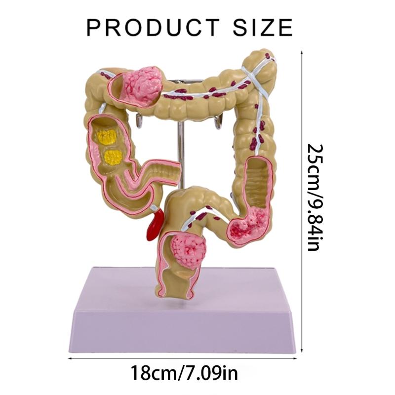 Menschliches Dickdarmmodell für Anatomie, Medizin, Lehrmodell, Pathologien des Dickdarmmodells für Studium und Ausstellung