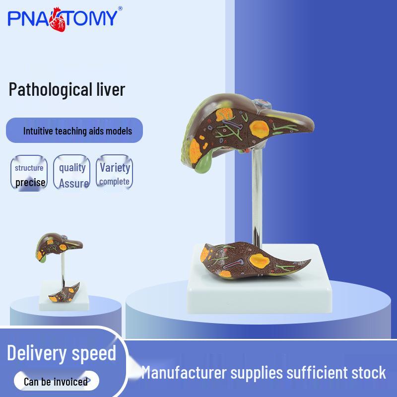 Liver and Gallbladder Pathology Model: Gallstones and Bile Demonstration 11x11x15 cm