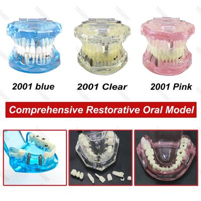 1 Piece Dental Model Teeth Resins Model With Restoration Bridge Teaching Teeth Repair Fit Dentistry Disease Teaching Study