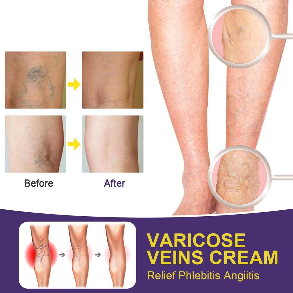 Varicose Veins Cream-Relief Phlebitis Angiitis-Promote Blood Circulation-Repair Skin Elasticity-Suitable For All Skin Types, 20g
