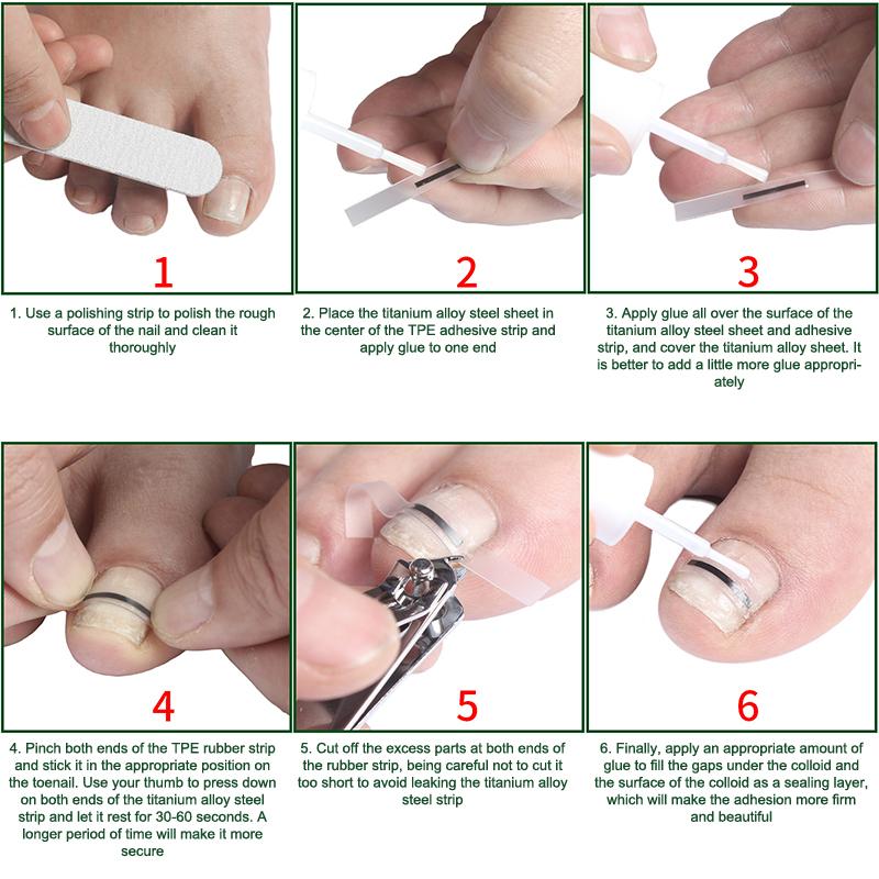 1Pcs Toenail Straightening Clip Ingrown Toenail Correction Tool Nail Treatment Elastic Patch Sticker Foot Care Pedicure