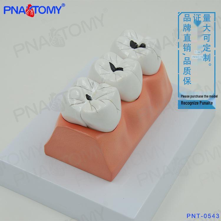 Dental Anatomy Model: Tooth Caries Pathology Display for Teaching 12 x 7 x 8 cm