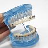 Dental Orthodontic Teeth Tooth Model 4 Kinds Brackets Ceramic and Metal Brackets for Patient Communication Dental Study Model