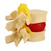 1:1.5 Lumbar Disc Herniation Demonstration Model Study Learn Human Spine