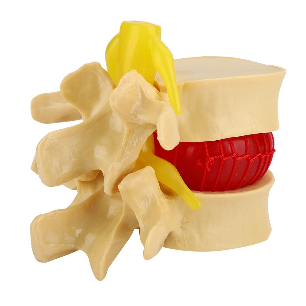 1:1.5 Lumbar Disc Herniation Demonstration Model Study Learn Human Spine