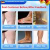 Ointment for Treating Varicose Veins