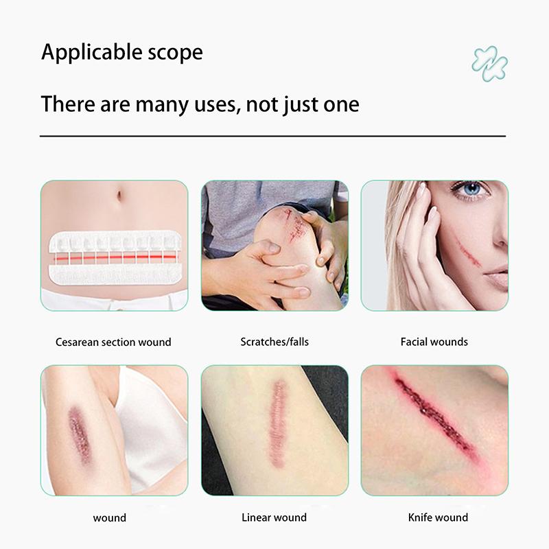 1 Sheet Fast Suture Zipper Band-Aid Zipper Tie Wound Closure Patch Hemostatic Patch Wound Outdoor Portable