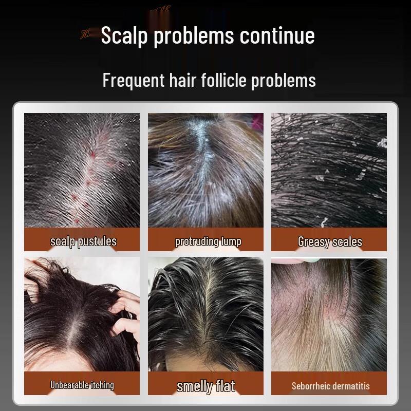 Baijiakang Coal Tar Medicated Shampoo for Dandruff & Seborrheic Dermatitis