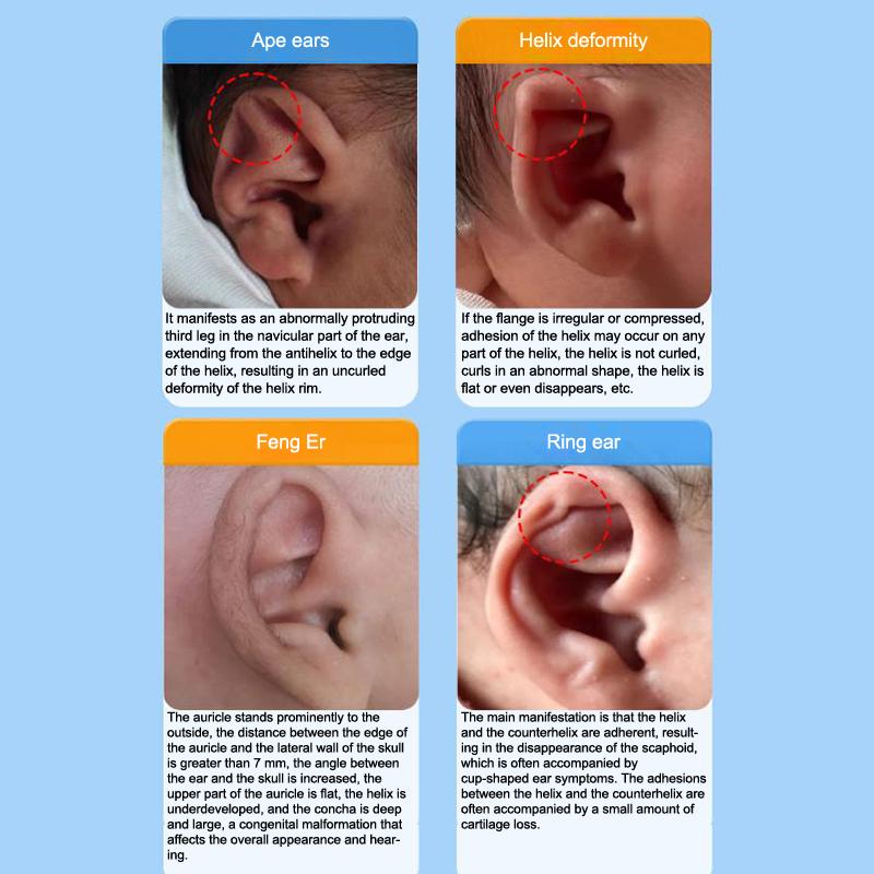 Protruding Ear Support Infant Corrector Tools Silicone Auricle Correction Patch For Baby Ear Corrector Auricle Valgus Correction