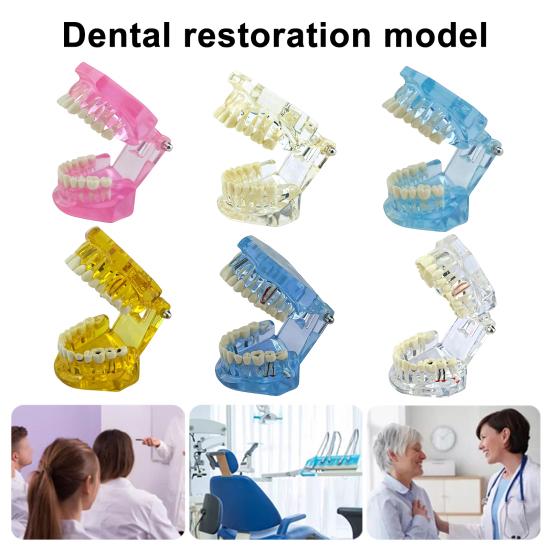 Dental Implant Model Teaching Aid for Dentist Student School Removable Teeth