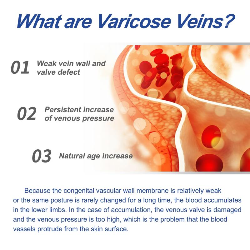 Treatment Creams Soothing Painness Eliminate Vasculitis Phlebitis Remove Spider Leg Angiitis Improvement Ointment