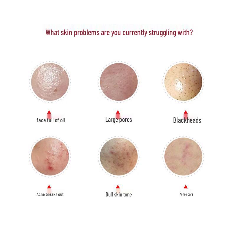 Junxian Acne Clearing Face Wash