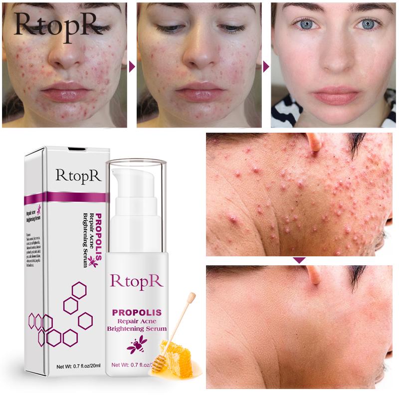 propolis e acne