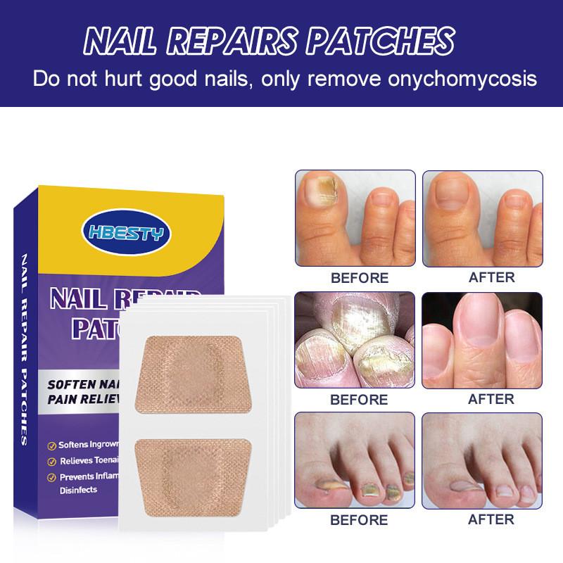 Hbesty Toenail Repair Patches For Damaged Soft Nails With Herbal Scented Comfort 40 Count