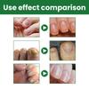 Eelhoe Nail Care Solution For Fungal Toenail Treatment With Nourishing Moisture