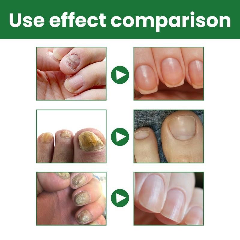 Eelhoe Nail Care Solution For Fungal Toenail Treatment With Nourishing Moisture
