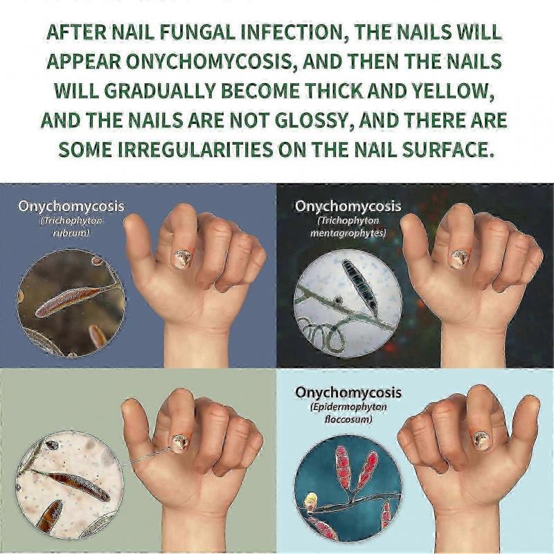 Jaysuing 7 Days Nail Fungus Treatment, Fast-Acting Nail Repair Serum with Ginger Formula, Promotes Healthy Nail Growth